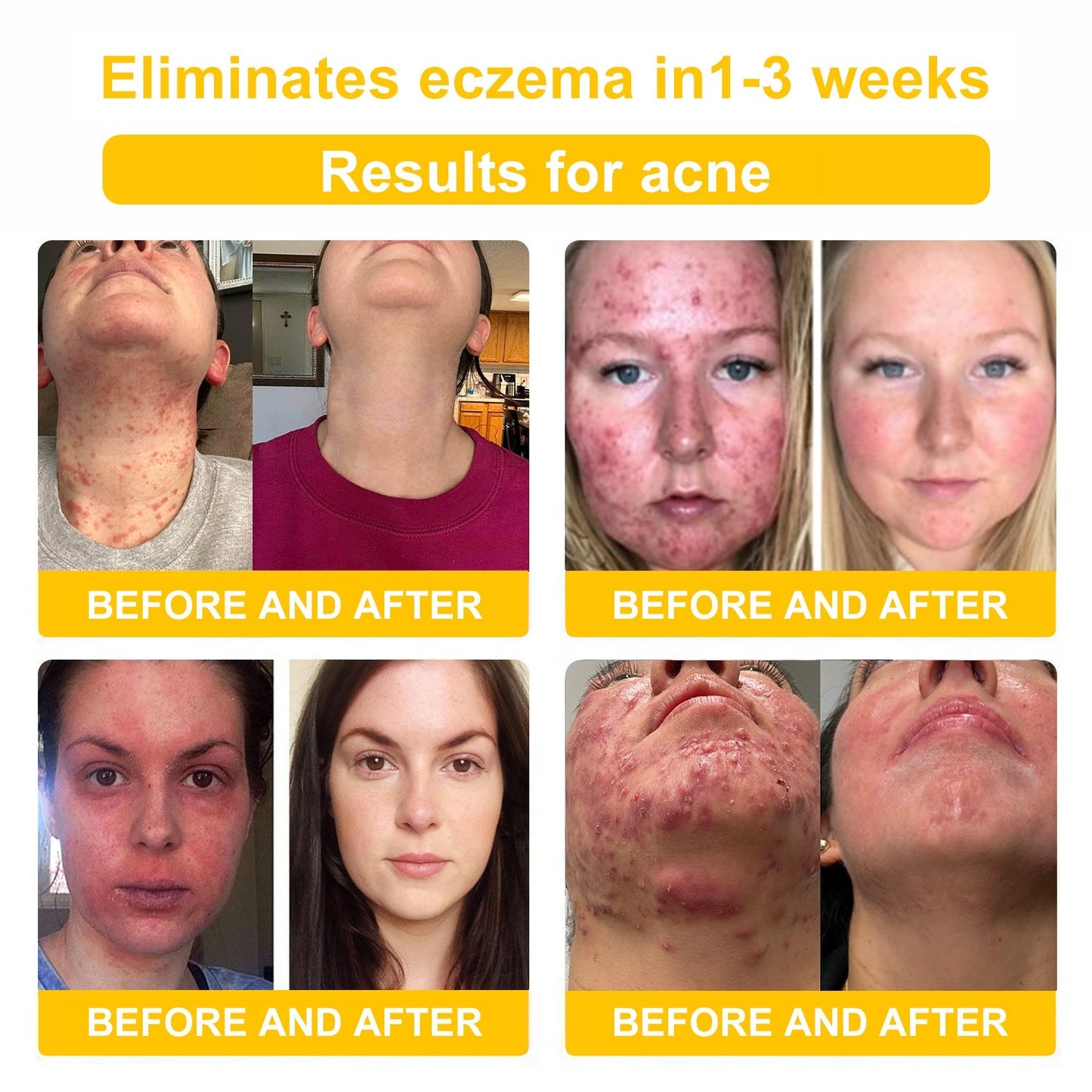 NESLEMY™ Bee Venom Skin Cream(👨⚕AAD Recommended),for Remove Warts, Acne and Scars