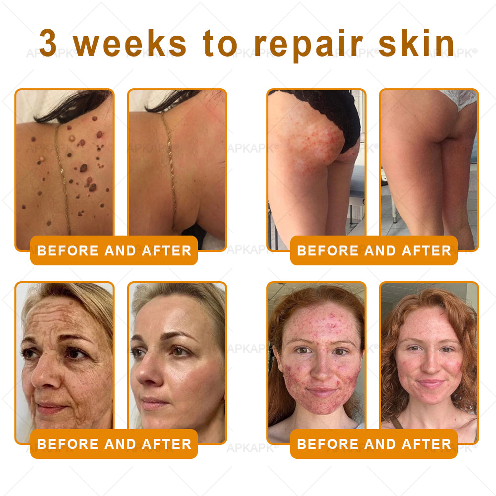 Made and Shipped from USA 🌞 𝖡𝖾𝖾 𝗏𝖾𝗇𝗈𝗆 𝖲𝗄𝗂𝗇 𝖱𝖾𝗌𝗍𝗈𝗋𝖺𝗍𝗂𝗈𝗇 𝖢𝗋𝖾𝖺𝗆