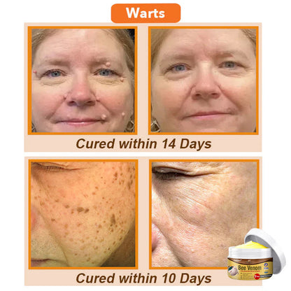 ⏰[Official Brand Store 24-Hours Promotion Buy 1 Get 1 Free]: 🐝Zakdavi™ Bee Venom Comprehensive Cream US Dermatologist Recommended