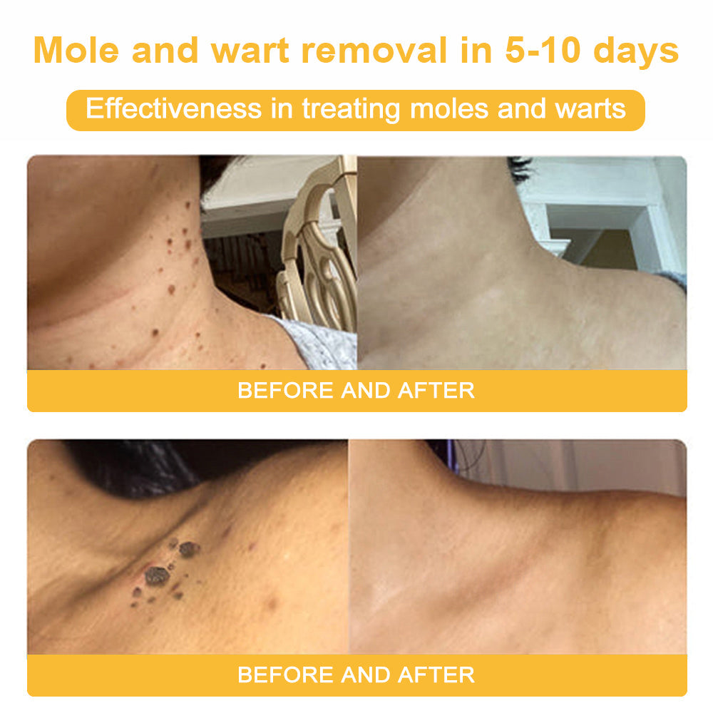 NESLEMY™ Bee Venom Skin Cream（👨‍⚕AAD Recommended),for Remove Warts, Acne and Scars