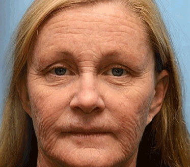 🐝🌳🌳🌳🌳Made and Shipped from USA✨Furzero™ Botox Bee Venom Wrinkle Removal Cream-🔥LAST DAY 70% OFF