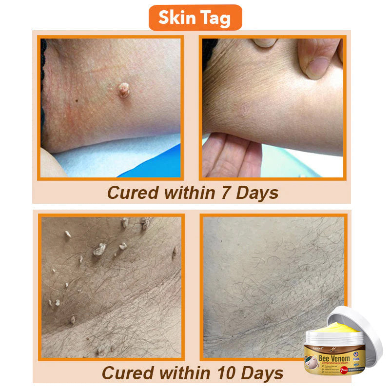 ⏰[Official Brand Store 24-Hours Promotion Buy 1 Get 1 Free]: 🐝Zakdavi™ Bee Venom Comprehensive Cream US Dermatologist Recommended