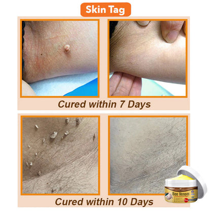 ⏰[Official Brand Store 24-Hours Promotion Buy 1 Get 1 Free]: 🐝Zakdavi™ Bee Venom Comprehensive Cream US Dermatologist Recommended