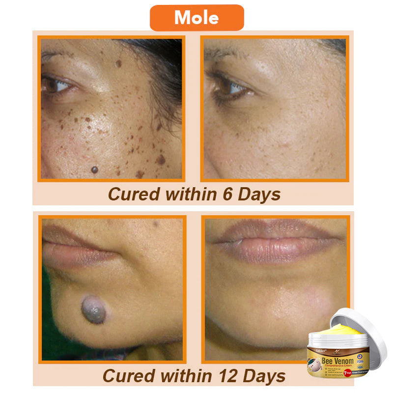 ⏰[Official Brand Store 24-Hours Promotion Buy 1 Get 1 Free]: 🐝Zakdavi™ Bee Venom Comprehensive Cream US Dermatologist Recommended