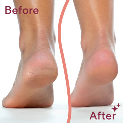 🌟2025 New rechargeable electric foot file exfoliator