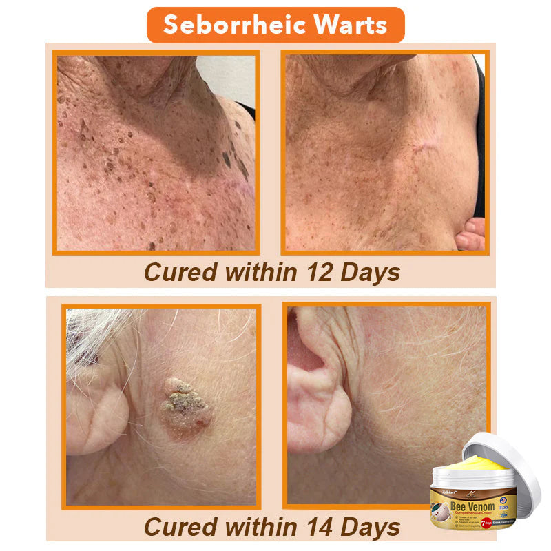 ⏰[Official Brand Store 24-Hours Promotion Buy 1 Get 1 Free]: 🐝Zakdavi™ Bee Venom Comprehensive Cream US Dermatologist Recommended